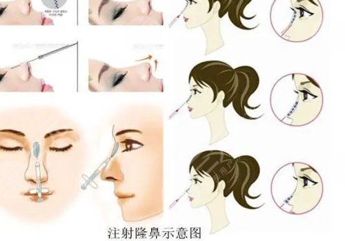 愛貝芙隆鼻會變寬嗎？