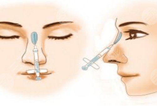 愛貝芙隆鼻會變寬嗎？