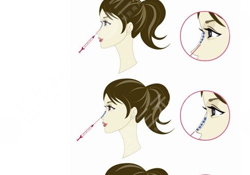 愛貝芙隆鼻會變寬嗎？