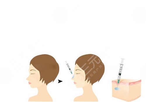 愛貝芙隆鼻會變寬嗎？