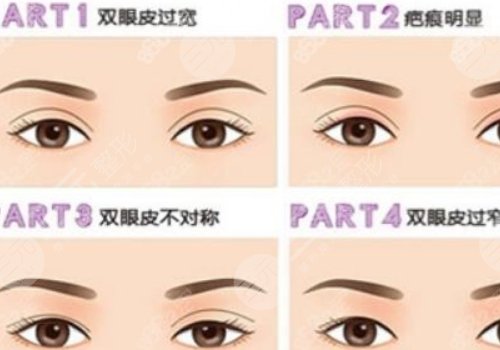 雙眼皮修復(fù)大概多少錢呢?