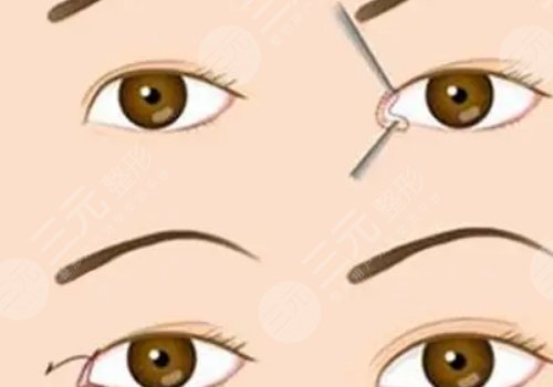 雙眼皮修復(fù)大概多少錢呢?