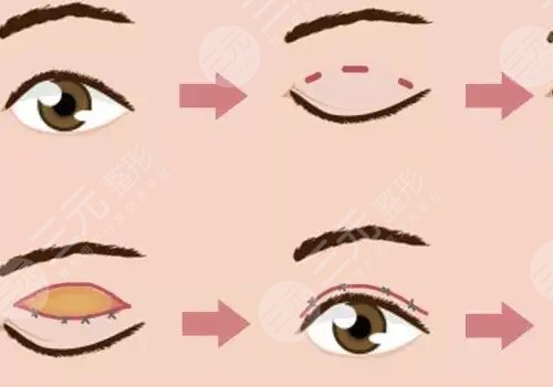 雙眼皮修復(fù)大概多少錢呢?