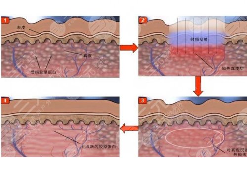 深藍射頻做一次有效果嗎？