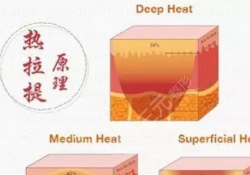 深藍(lán)射頻和熱拉提哪個(gè)好？
