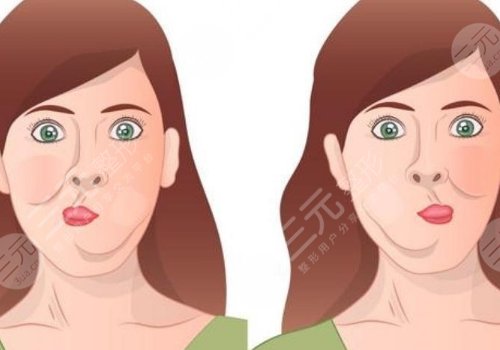 深藍(lán)射頻和熱拉提哪個(gè)好？