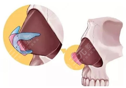 鼻小柱抬高是怎么做的？