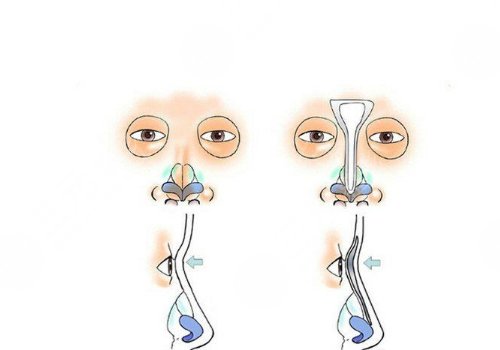 鼻小柱抬高是怎么做的？