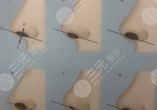 鼻小柱抬高是怎么做的？