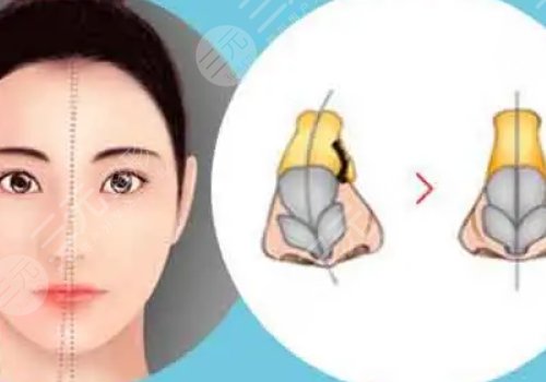 鼻小柱抬高是怎么做的？