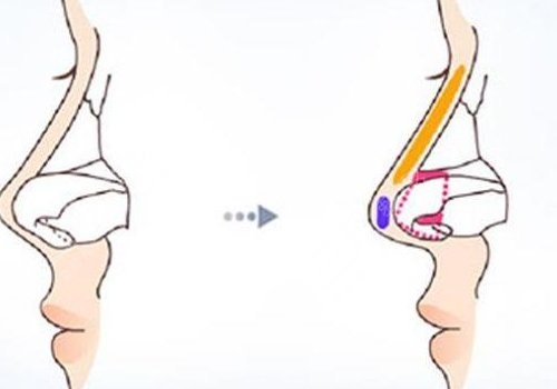 鼻小柱歪斜怎么修復(fù)？