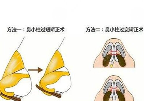 鼻小柱歪斜怎么修復(fù)？