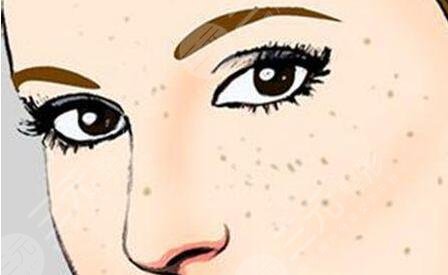 關(guān)于祛斑的方法有哪些是正確的?