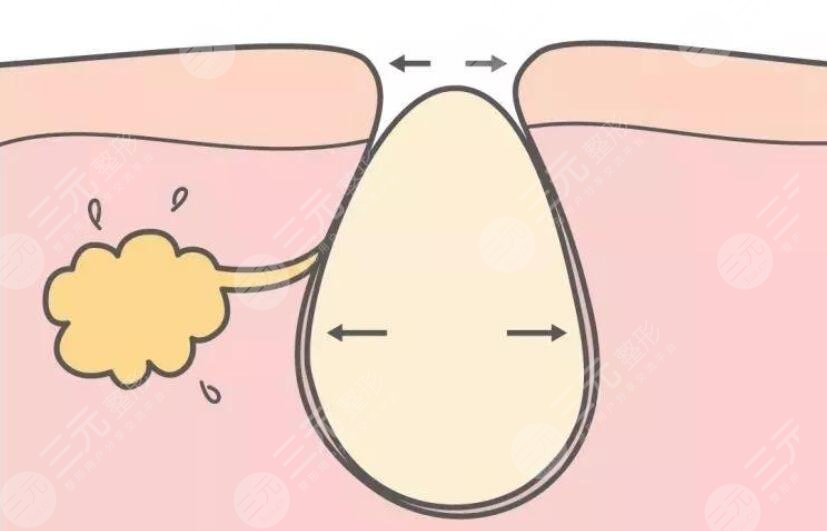 解讀！   激光緩解毛孔粗大
