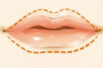 豐唇