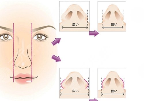 鼻小柱延長原因介紹