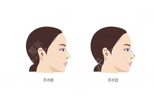 鼻小柱延長原因介紹