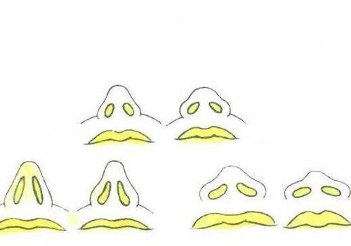 鼻小柱延長原因介紹