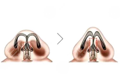 鼻小柱延長可以改良什么？