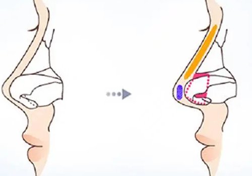 鼻小柱延長原因介紹