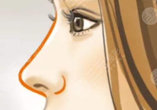 膠原蛋白隆鼻會(huì)變寬嗎？