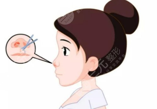 膠原蛋白隆鼻會(huì)變寬嗎？