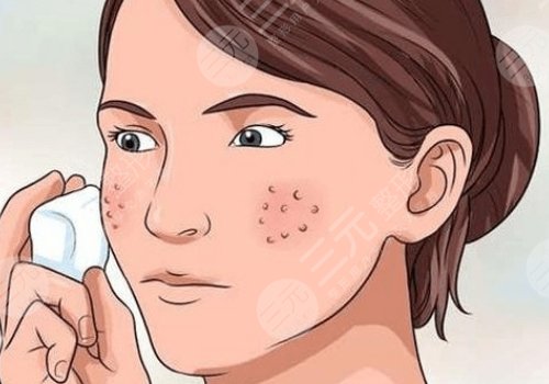 祛痘印痘坑好的方法