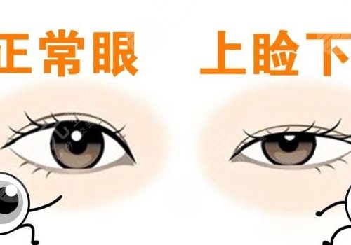 上瞼下垂矯正大概需要多少費用？