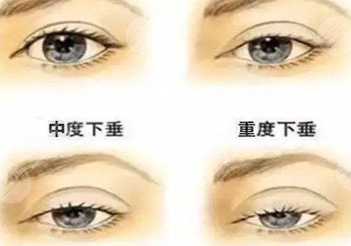 上瞼下垂矯正大概需要多少費用？