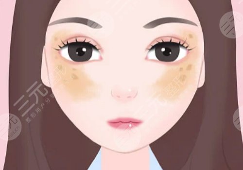 去除黃褐斑價(jià)格是多少？