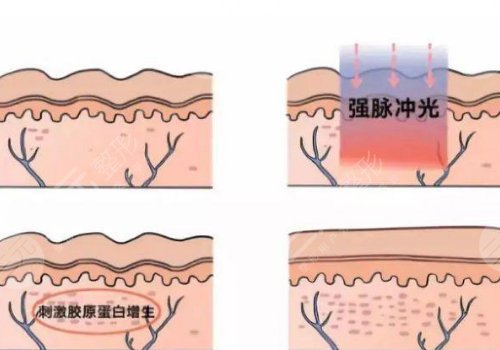 激光去疤痕需要幾次才能徹底消除？