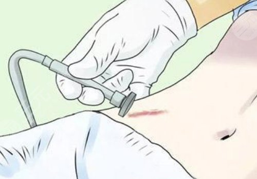 激光去疤痕需要幾次才能徹底消除？