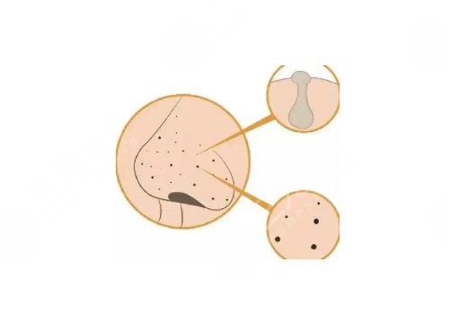 去黑頭收縮毛孔好的方法有哪些？