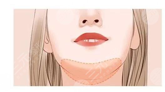 瑞蘭2號玻尿酸適合打哪里？