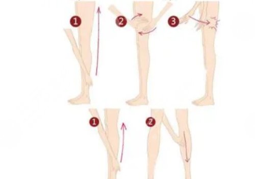 小腿吸脂大概要多少錢?