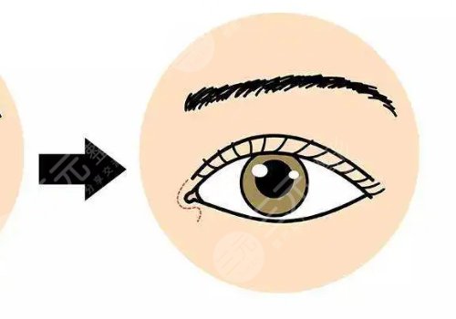 一般開內(nèi)眼角多少錢?