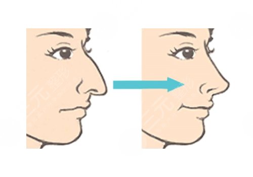 駝峰鼻矯正手術(shù)多少錢？