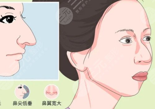 駝峰鼻矯正手術(shù)多少錢？