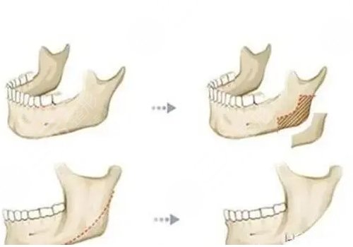 下頜角寬大怎么改良?