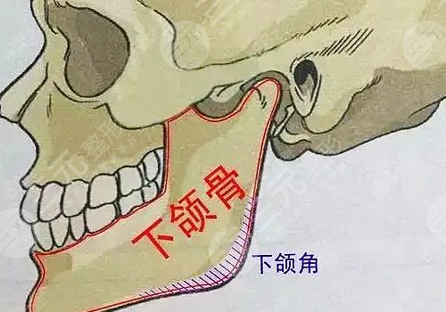 下頜角寬大怎么改良?