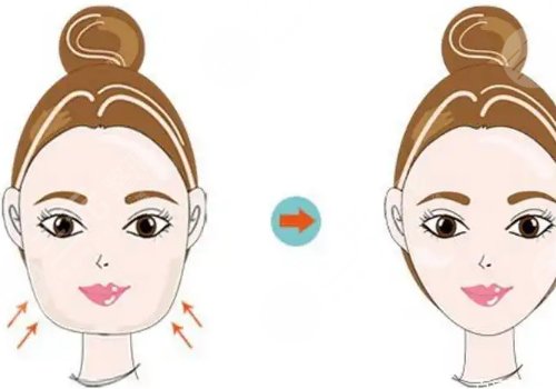 下頜角寬大怎么改良?
