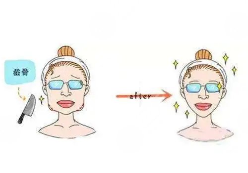 下頜角寬大怎么改良?