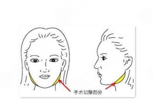 磨骨手術(shù)和削骨哪個更好?