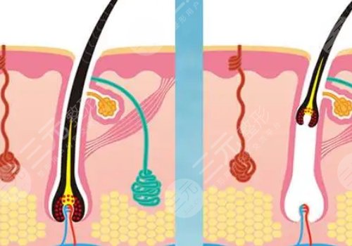 激光脫毛和冰點(diǎn)脫毛哪個(gè)好？