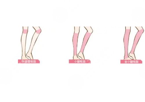 小腿吸脂恢復(fù)期要多久？有效果嗎？