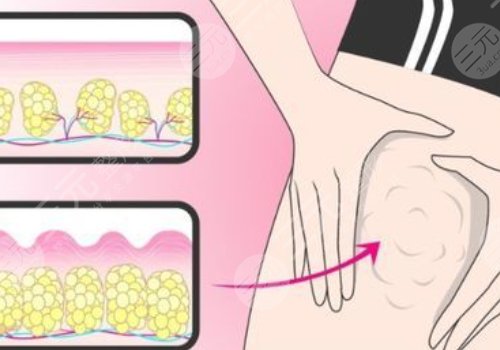 小腿吸脂恢復(fù)期要多久？有效果嗎？