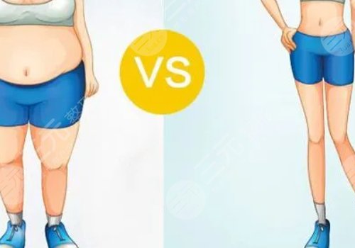 小腿吸脂恢復(fù)期要多久？有效果嗎？