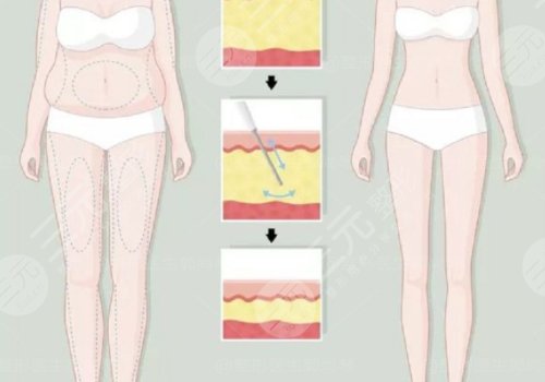小腿吸脂恢復(fù)期要多久？有效果嗎？