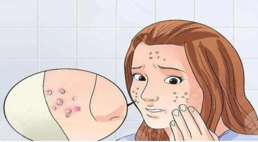 怎樣才能去除青春痘方法簡單有效？網(wǎng)友和網(wǎng)紅測評的8種小技巧，快來get