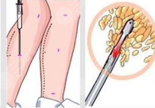 小腿吸脂后多久可以正常走路？